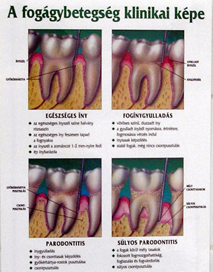 kezelés periodontális diabetes