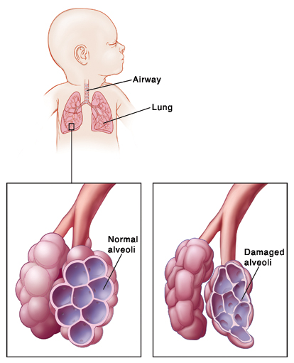 Az újszülött légzőrendszere. Ép és kóros alveolusok